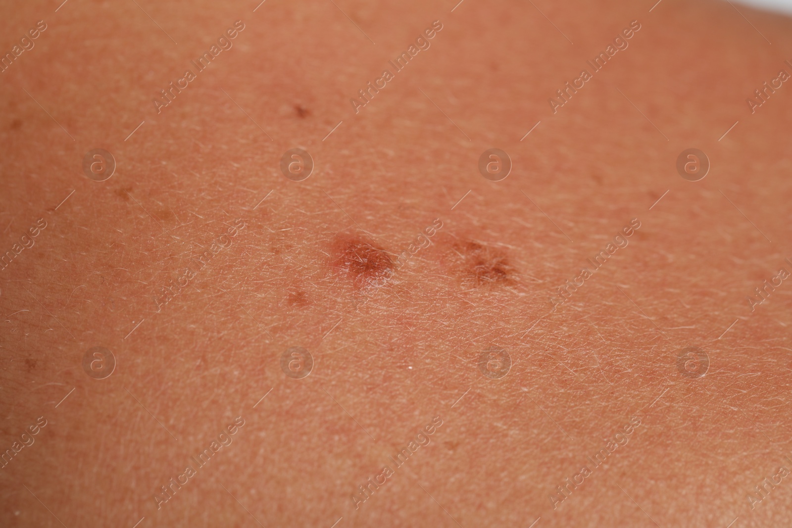 Photo of Woman with moles on her body, closeup