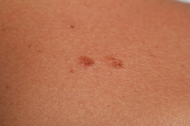 Photo of Woman with moles on her body, closeup