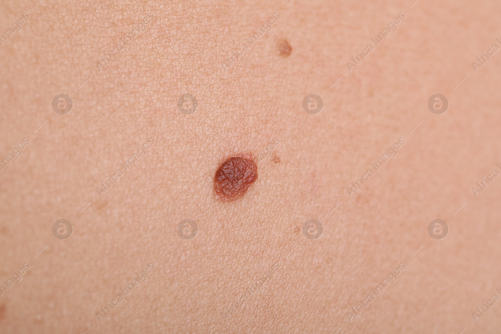 Photo of Woman with moles on her body, closeup