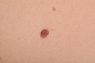 Photo of Woman with moles on her body, closeup