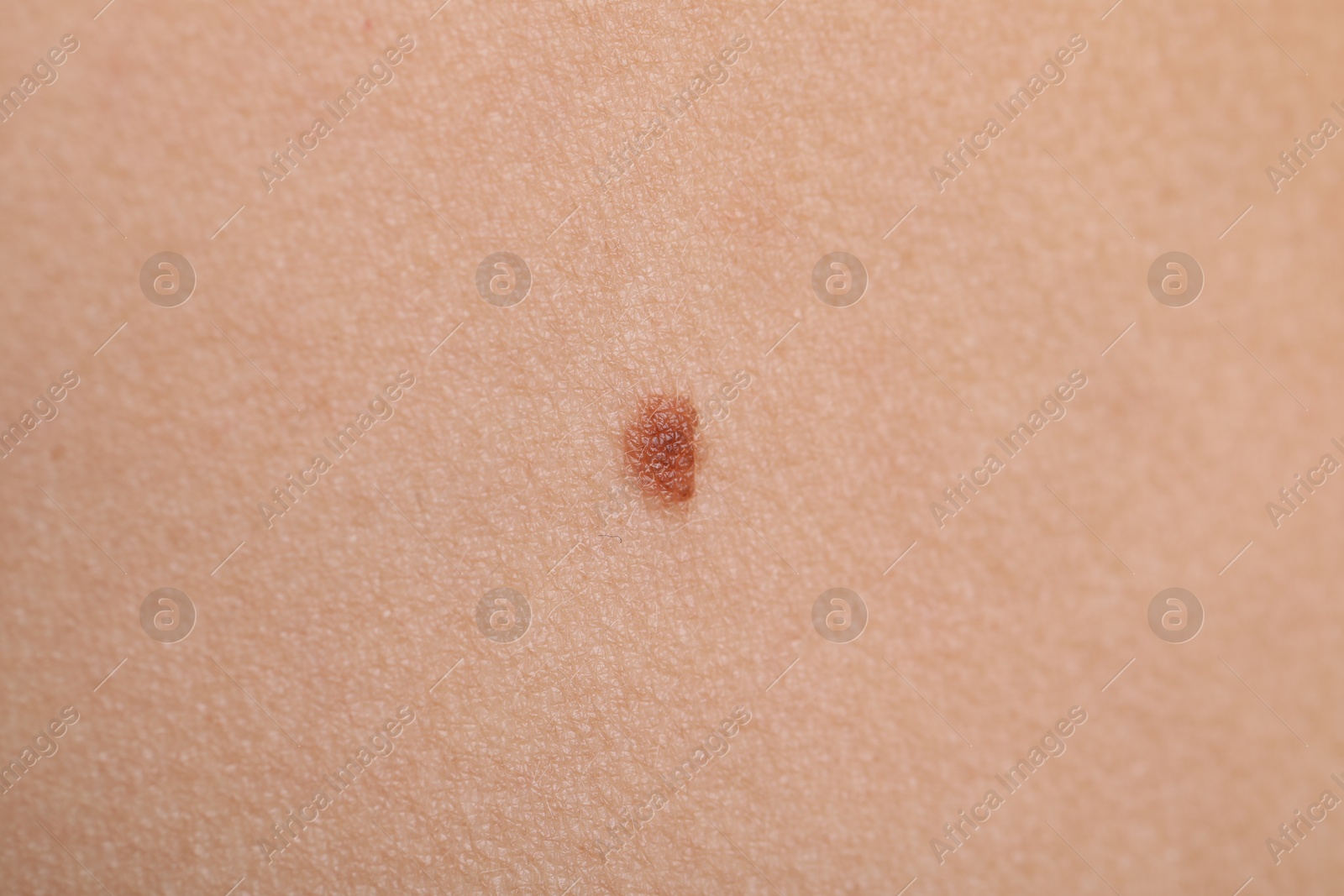 Photo of Woman with mole on her body, closeup