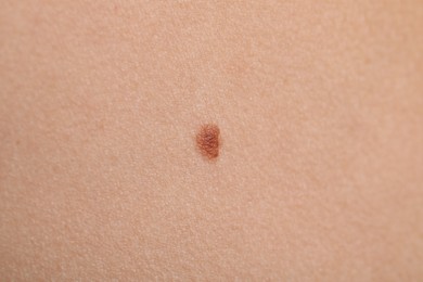 Photo of Woman with mole on her body, closeup