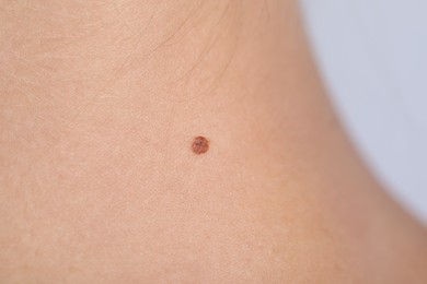 Photo of Woman with mole on her body against light grey background, closeup