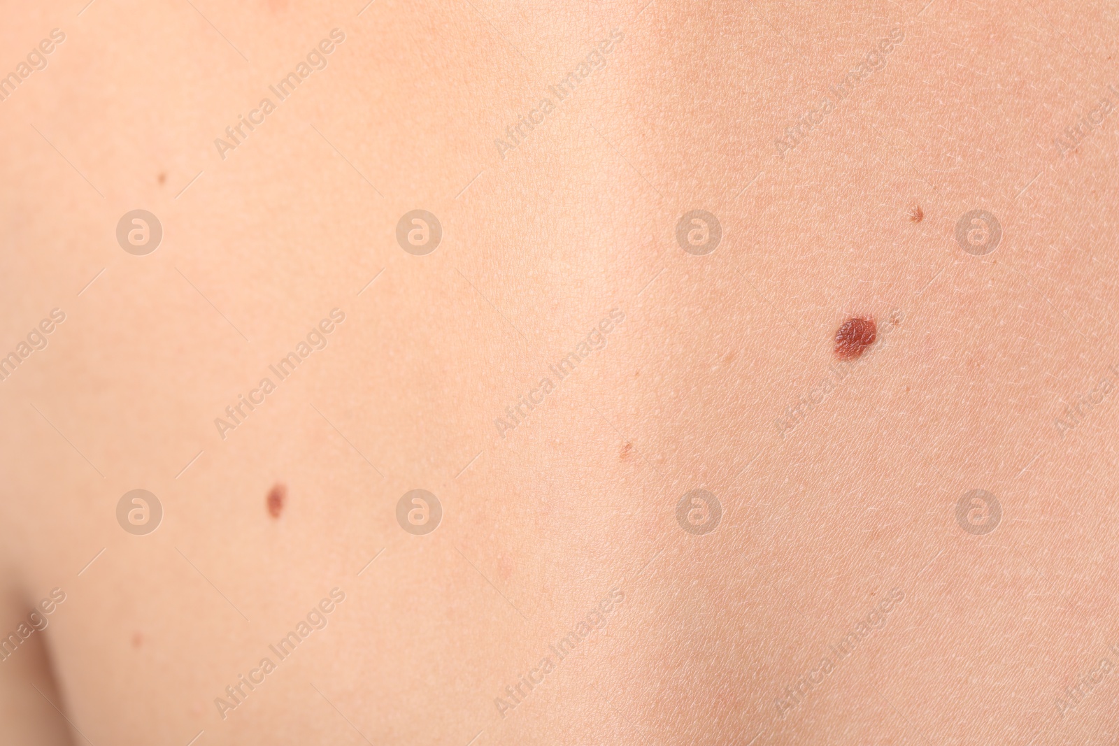 Photo of Woman with moles on her body, closeup