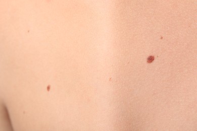 Photo of Woman with moles on her body, closeup