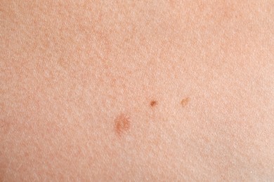 Photo of Woman with moles on her body, closeup