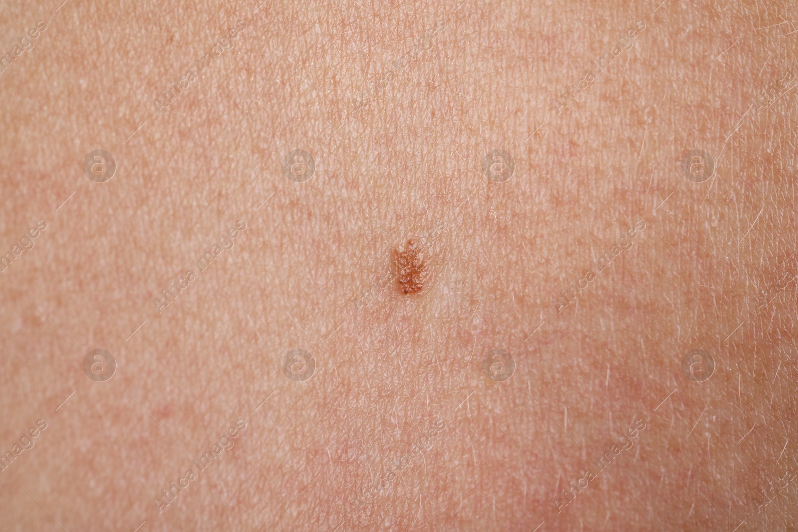 Photo of Woman with mole on her body, closeup