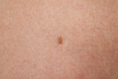 Photo of Woman with mole on her body, closeup