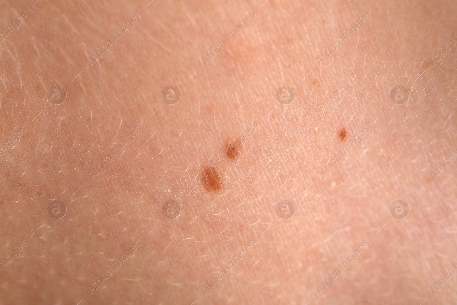 Photo of Woman with moles on her body, closeup