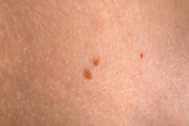 Photo of Woman with moles on her body, closeup