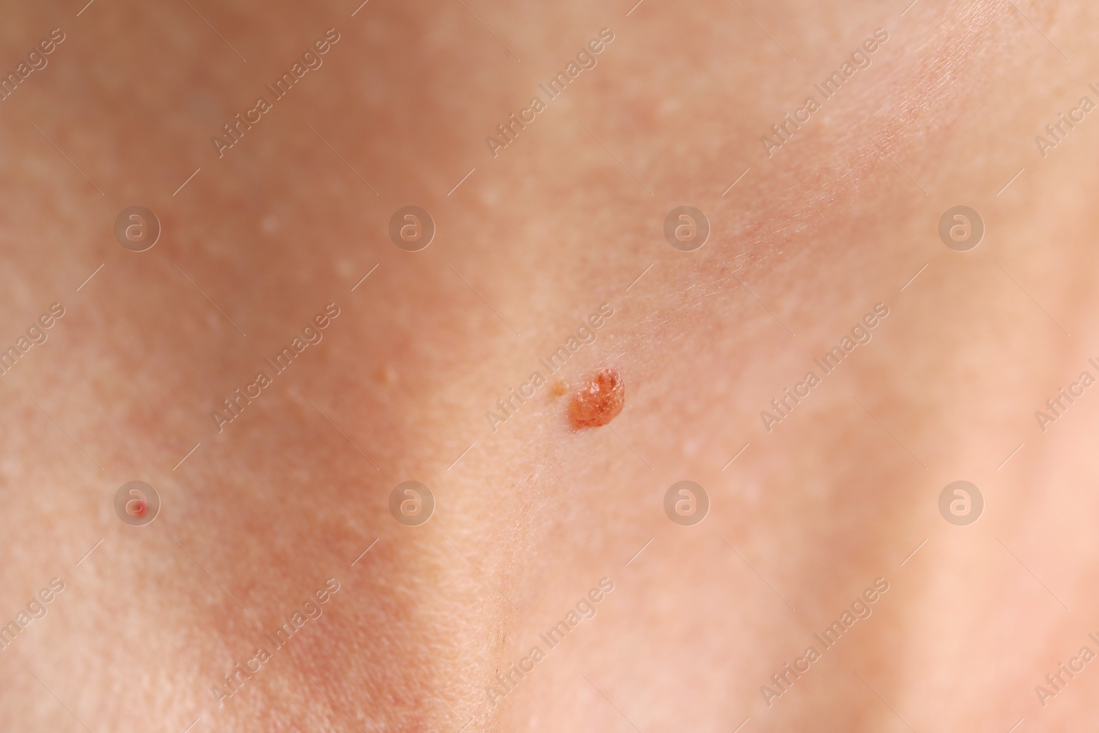 Photo of Woman with moles on her body, closeup