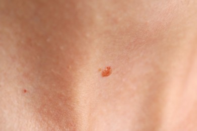 Photo of Woman with moles on her body, closeup
