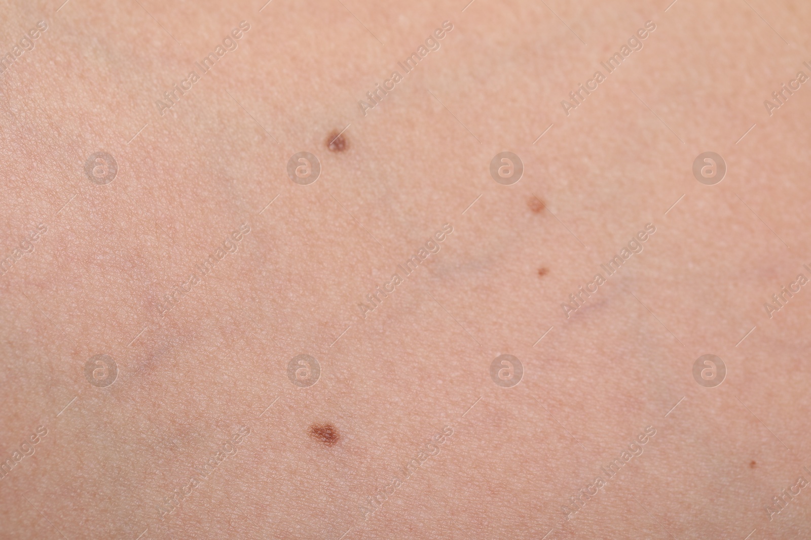 Photo of Woman with moles on her body, closeup