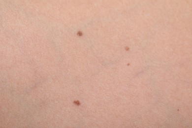 Photo of Woman with moles on her body, closeup