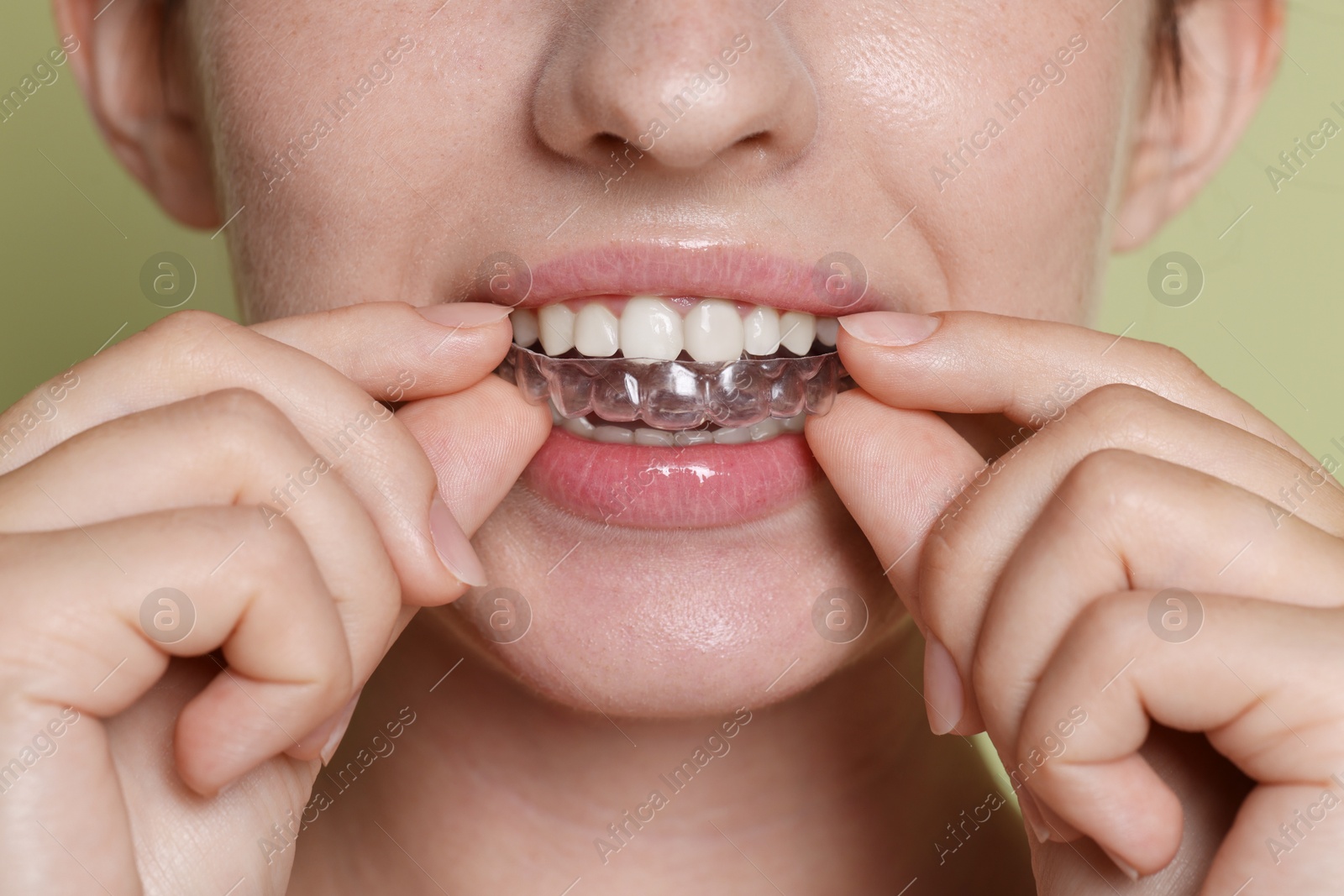 Woman wearing dental aligner on green background, closeup Photo of Woman wearing dental aligner on green background, closeup