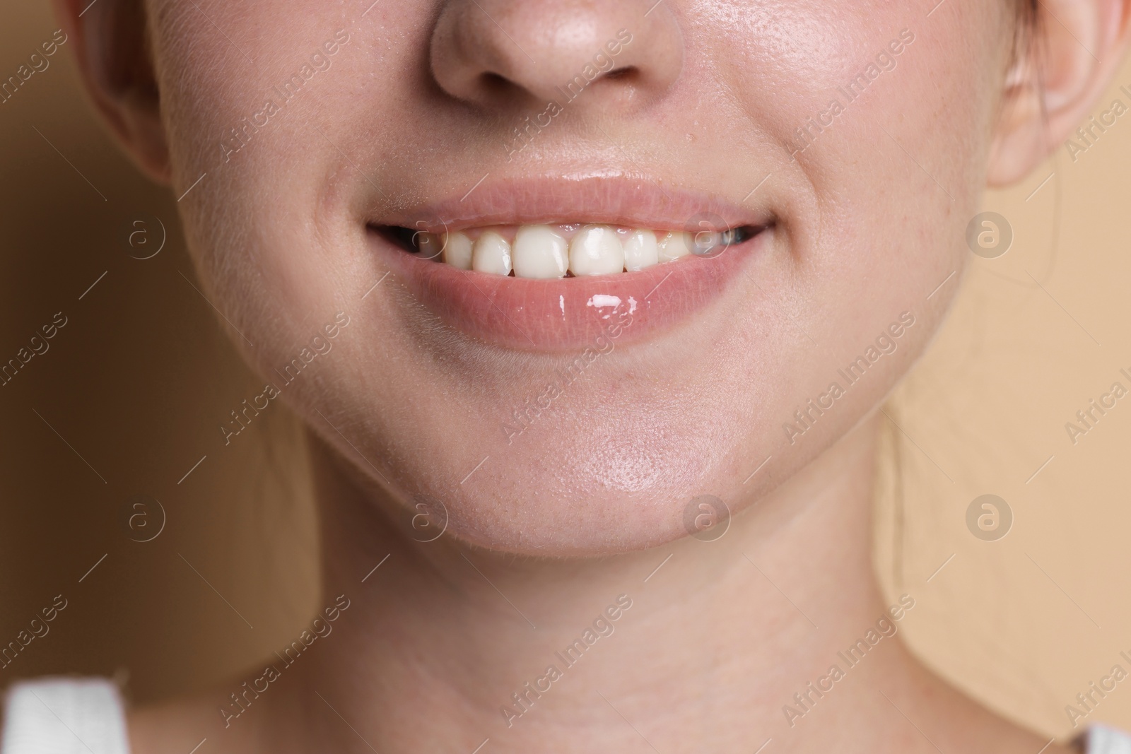 Smiling woman after dental aligners treatment on beige background, closeup Photo of Smiling woman after dental aligners treatment on beige background, closeup