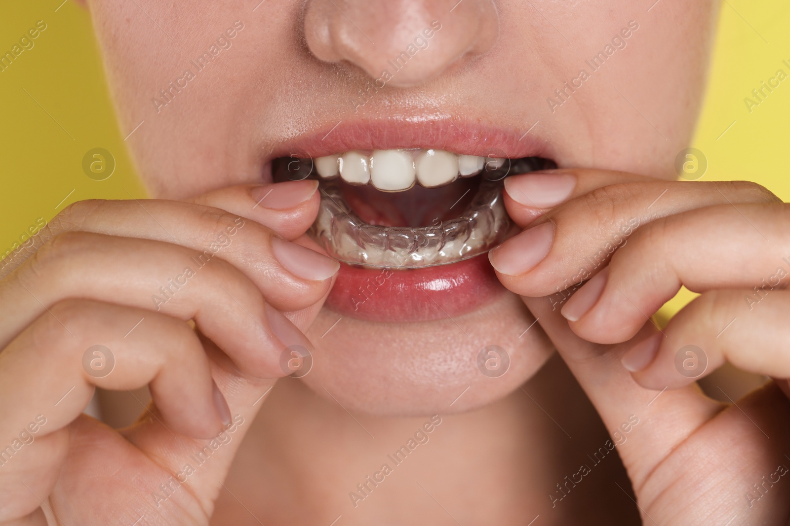 Woman wearing dental aligner on yellow background, closeup Photo of Woman wearing dental aligner on yellow background, closeup