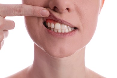 Image of Woman showing inflamed gum on white background, closeup