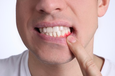 Image of Man showing inflamed gum on white background, closeup