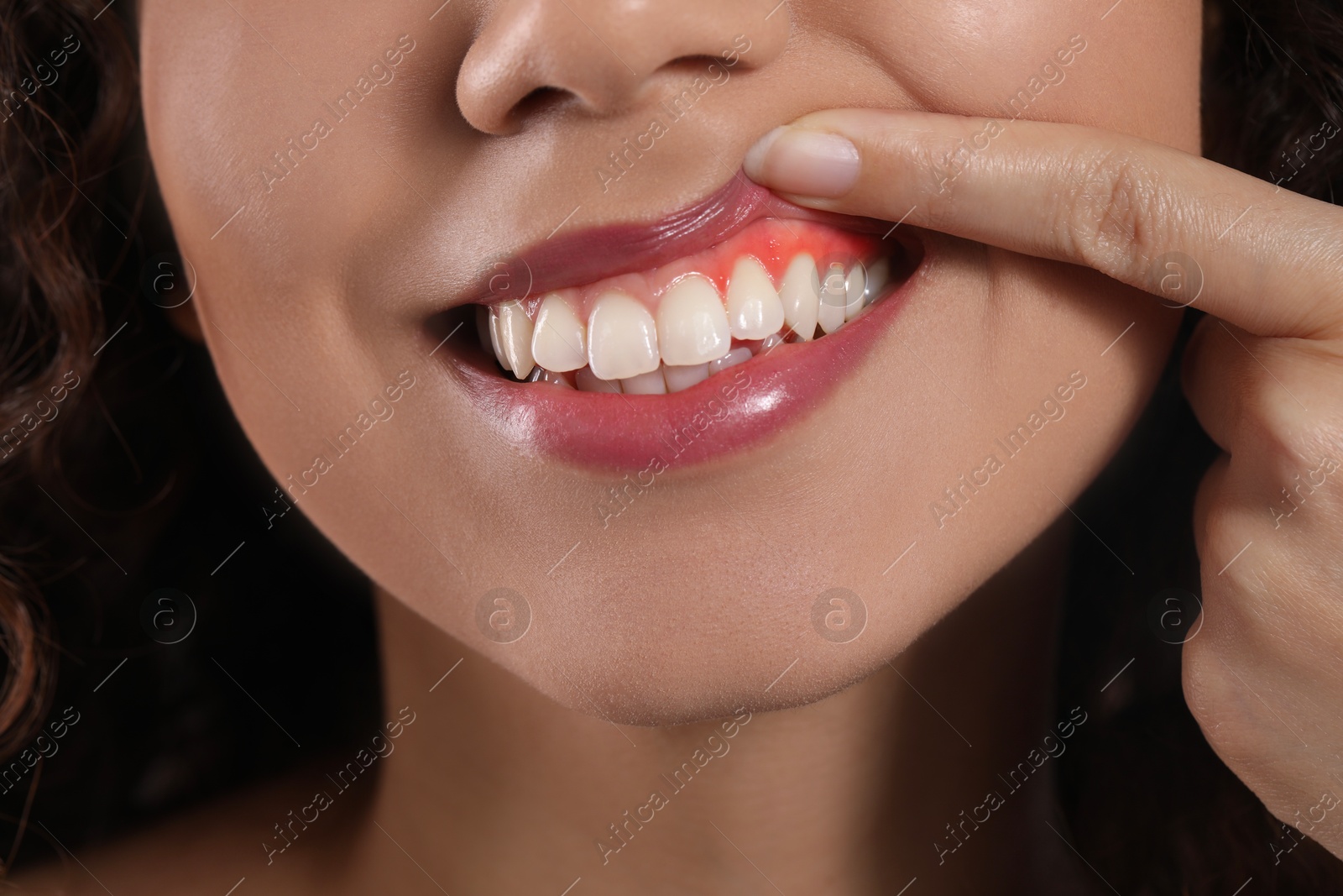 Woman showing inflamed gum, closeup. Oral health Image of Woman showing inflamed gum, closeup. Oral health