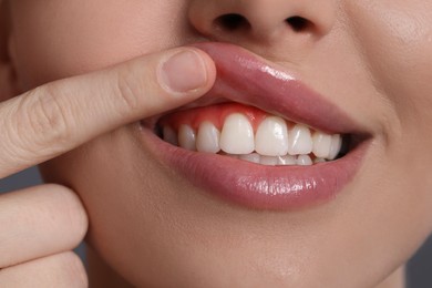 Image of Woman showing inflamed gum, closeup. Oral health