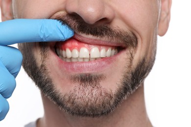 Image of Doctor examining man's inflamed gum on white background, closeup