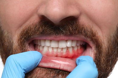 Image of Doctor examining man's inflamed gum, closeup. Oral health