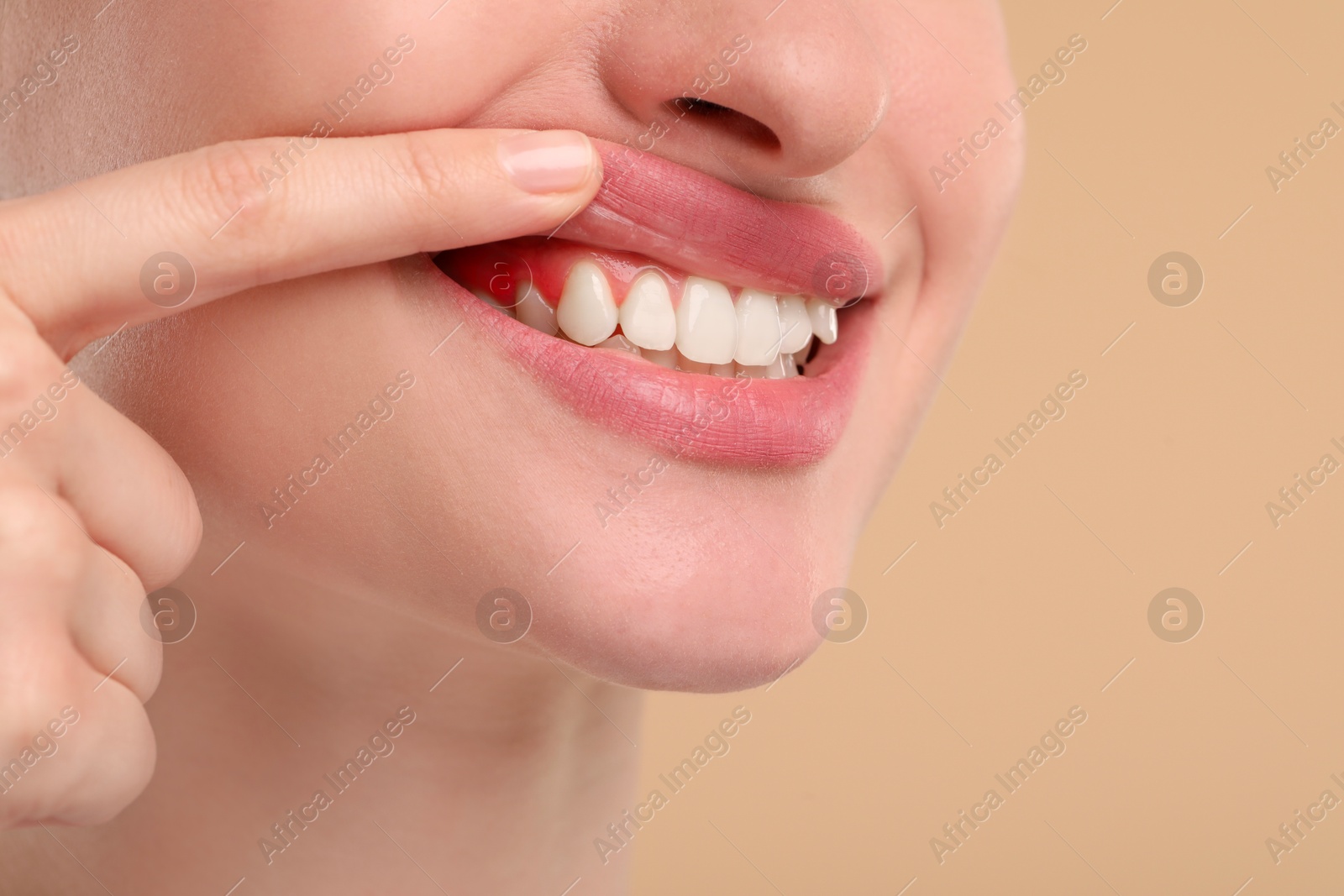 Image of Woman showing inflamed gum on beige background, closeup