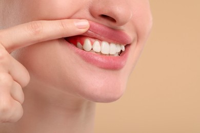 Image of Woman showing inflamed gum on beige background, closeup