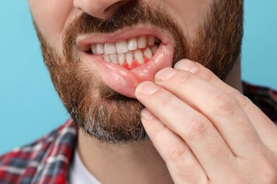 Image of Man showing inflamed gum on light blue background, closeup