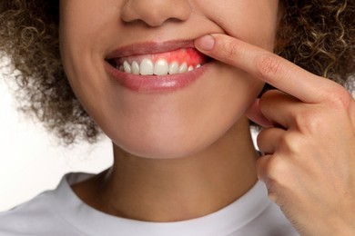 Image of Woman showing inflamed gum on white background, closeup