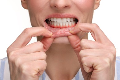 Image of Woman showing inflamed gum on white background, closeup