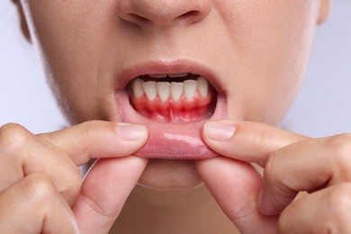 Image of Woman showing inflamed gum on light background, closeup