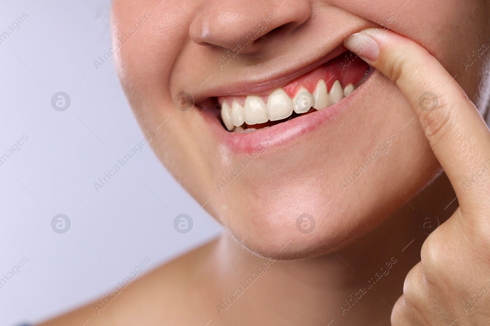 Woman showing inflamed gum on light background, closeup Image of Woman showing inflamed gum on light background, closeup