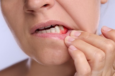 Image of Woman showing inflamed gum on light background, closeup