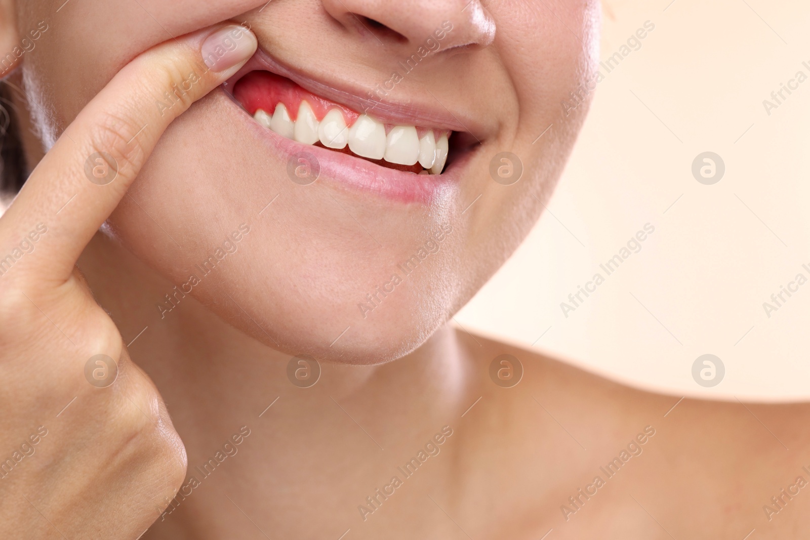 Woman showing inflamed gum on beige background, closeup Image of Woman showing inflamed gum on beige background, closeup