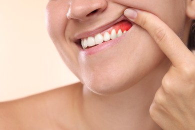 Image of Woman showing inflamed gum on beige background, closeup