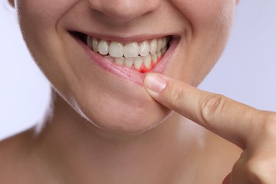Image of Woman showing inflamed gum on light background, closeup