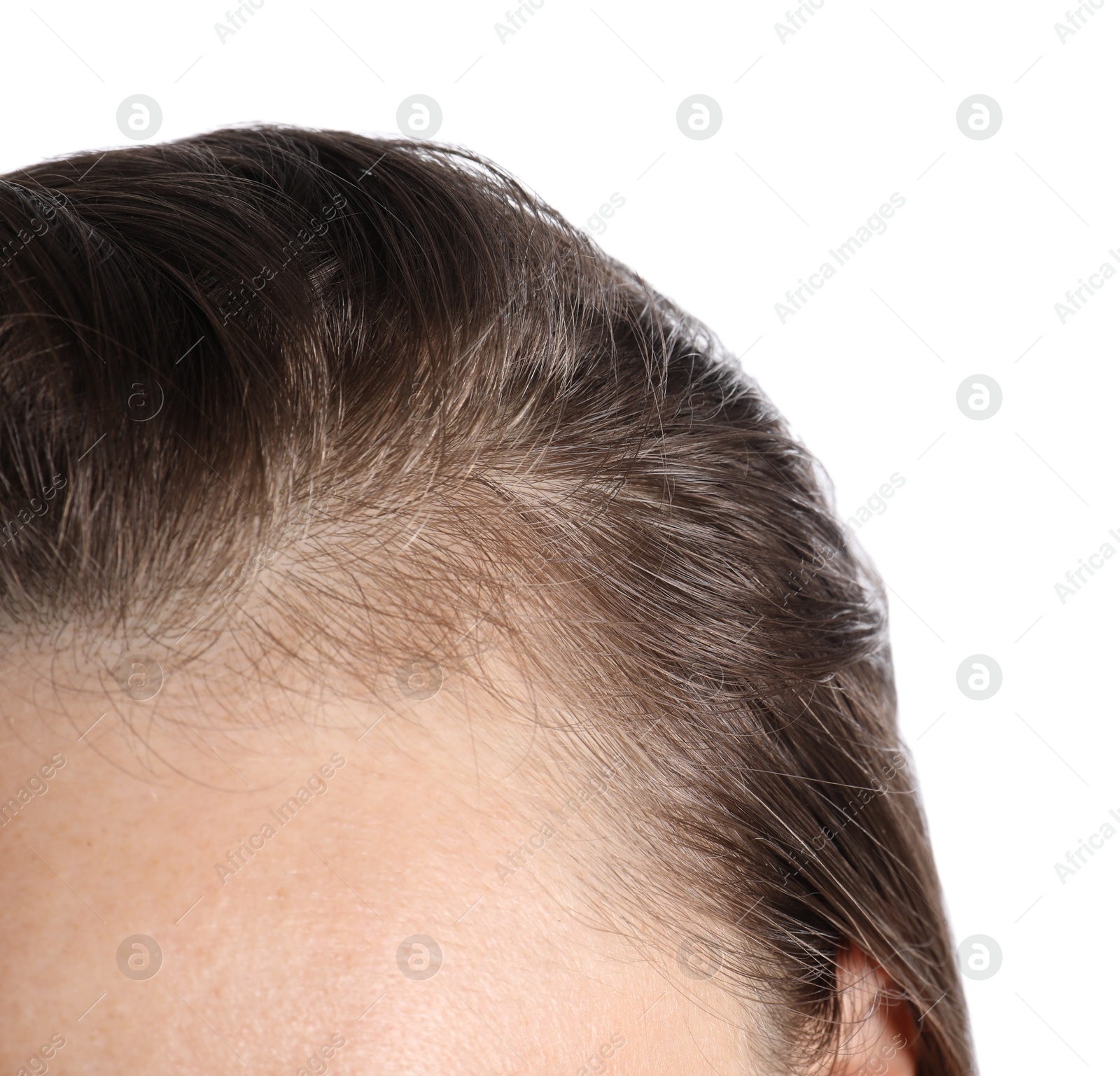 Photo of Woman after hair loss treatment on white background, closeup