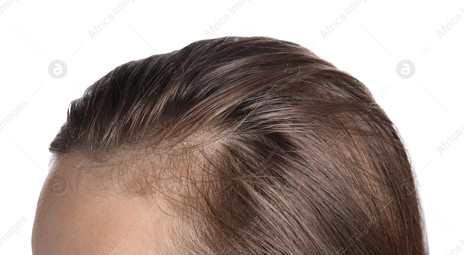 Photo of Woman after hair loss treatment on white background, closeup