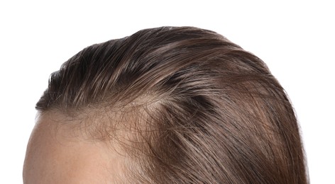 Photo of Woman after hair loss treatment on white background, closeup