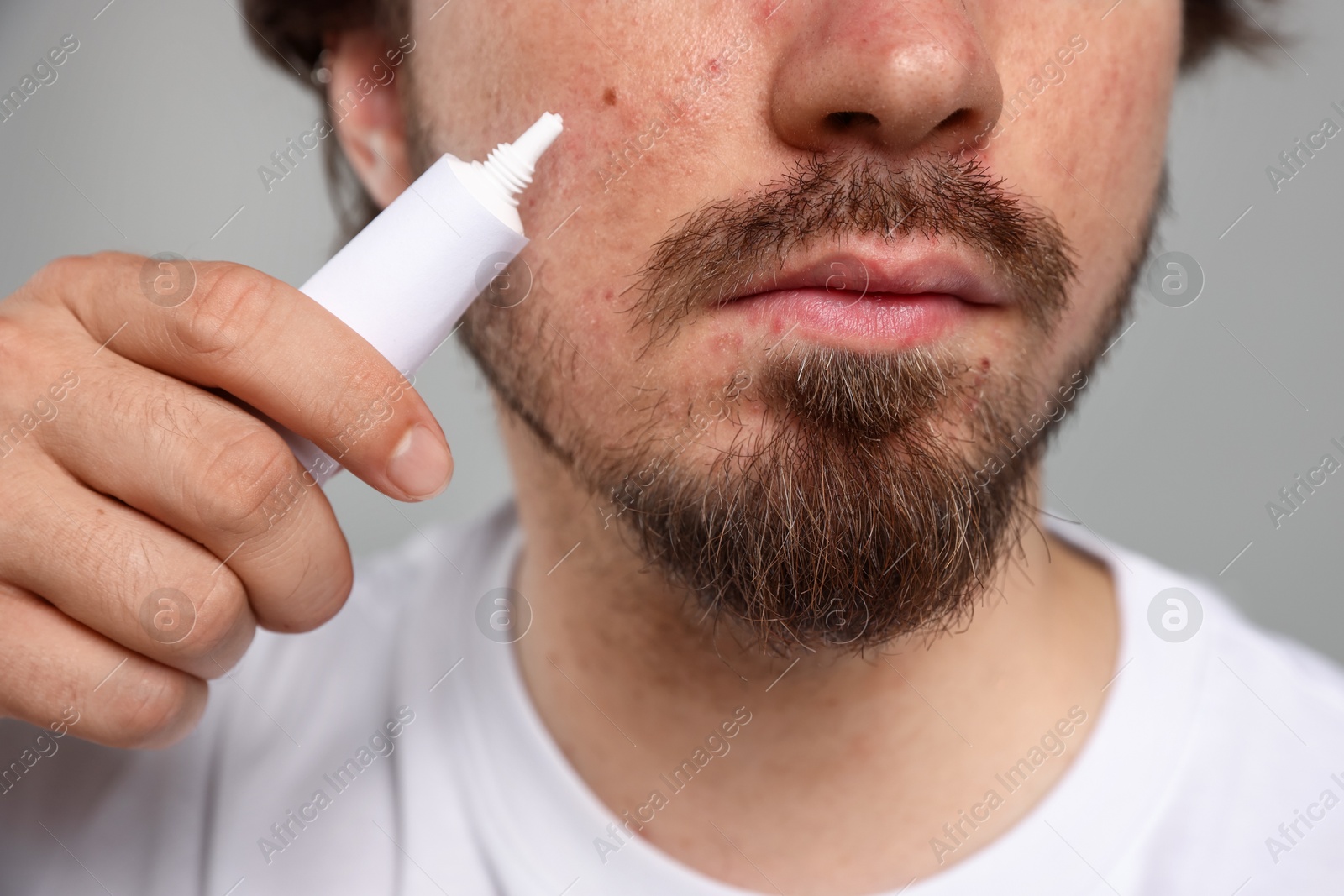 Young man with acne problem applying cream onto his face on light grey background, closeup Photo of Young man with acne problem applying cream onto his face on light grey background, closeup