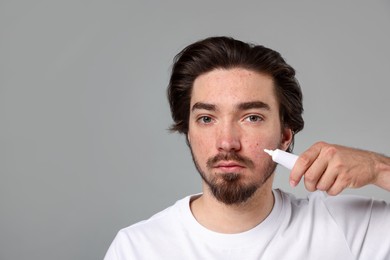Photo of Young man with acne problem applying cream onto his face on light grey background. Space for text