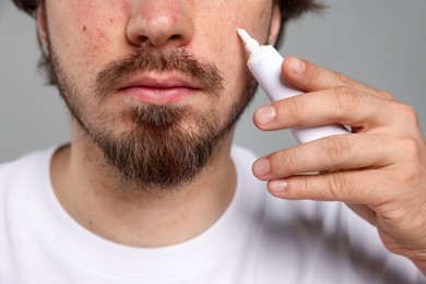 Photo of Young man with acne problem applying cream onto his face on light grey background, closeup