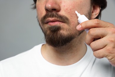 Photo of Young man with acne problem applying cream onto his face on light grey background, closeup