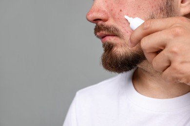 Photo of Young man with acne problem applying cream onto his face on light grey background, closeup. Space for text