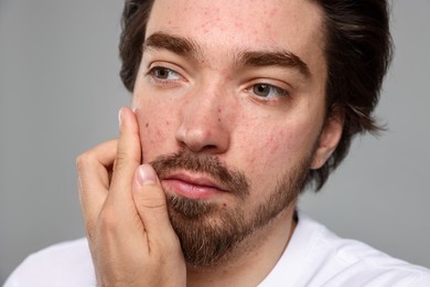 Photo of Young man with acne problem applying cream onto his face on light grey background, closeup