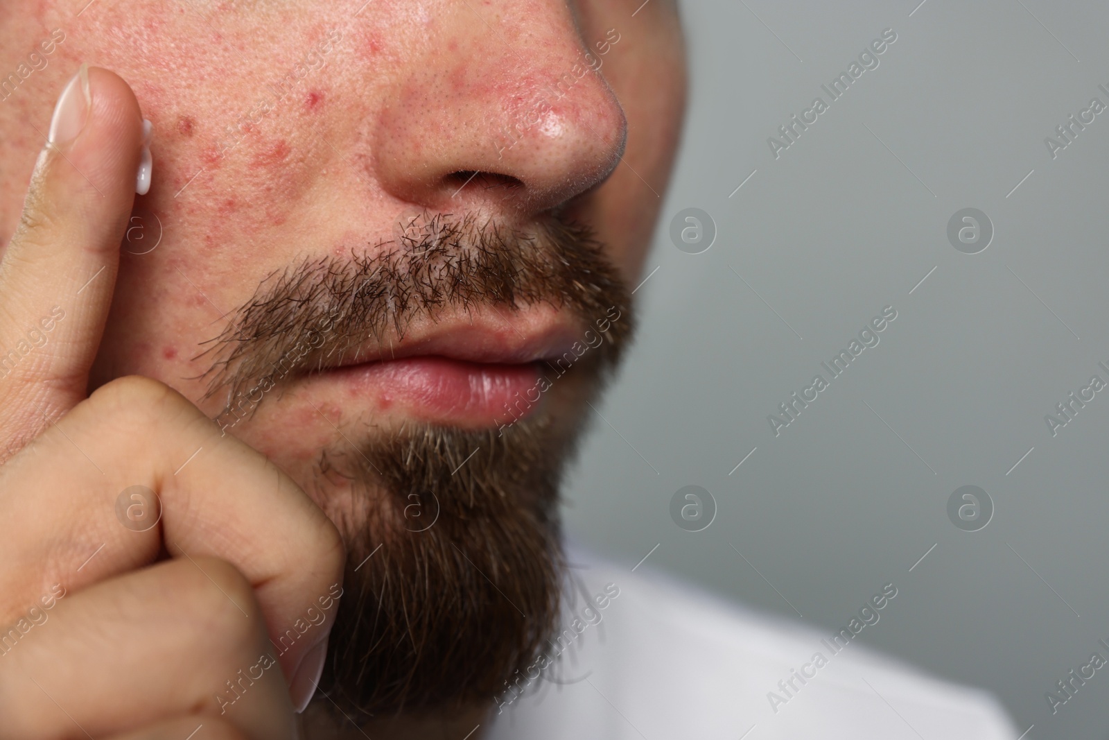 Young man with acne problem applying cream onto his face on light grey background, closeup. Space for text Photo of Young man with acne problem applying cream onto his face on light grey background, closeup. Space for text