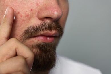 Photo of Young man with acne problem applying cream onto his face on light grey background, closeup. Space for text