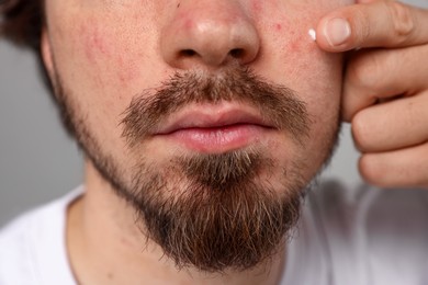Photo of Young man with acne problem applying cream onto his face on light grey background, closeup